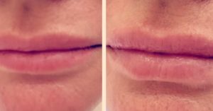 hydrafacial treatment lips before and after