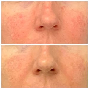 hydrafacial treatment nose before and after