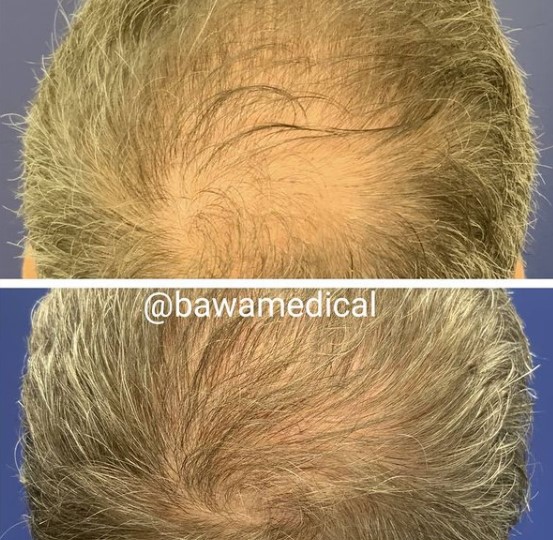 hair transplantation before and after