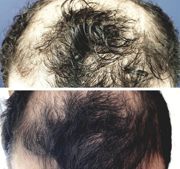 Male Pattern Baldness | Boca Raton, FL | Bawa Medical
