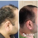 hair restoration before and after