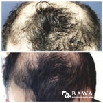 hair restoration before and after