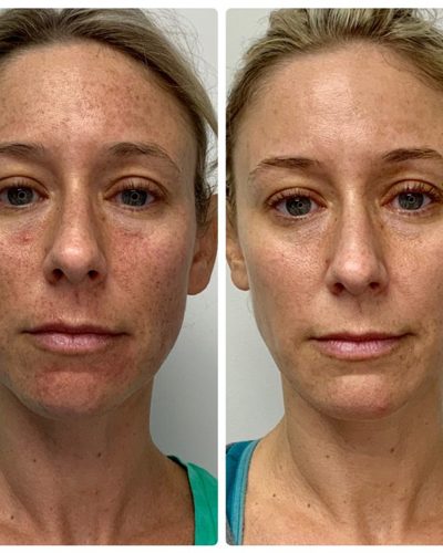 laser treatments before and after